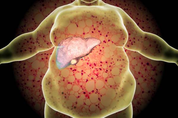 Fatty Liver Disease Treatment in Bangalore