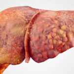 Liver disease