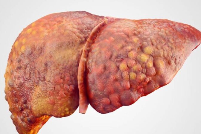 Liver disease