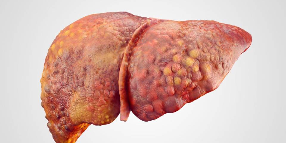 Liver disease